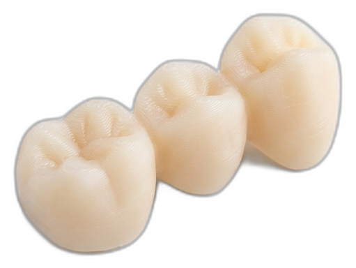 3D-printed crown and bridge